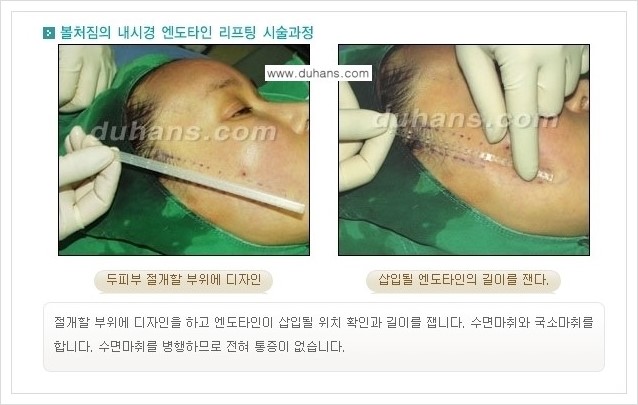 [두한성형외과 경쟁력 주름성형] - [주름제거 방법 안내] 관련 이미지 8