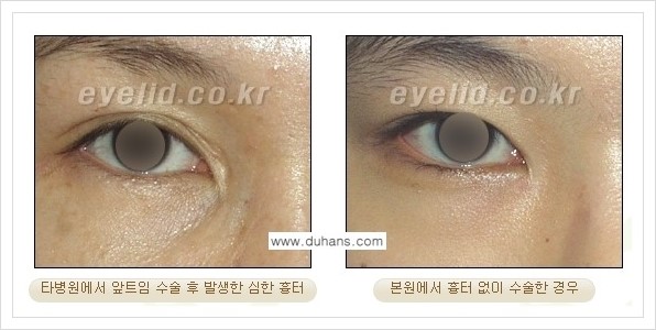 [두한성형외과 경쟁력 눈성형] - [흉터없는 몽고주름 제거 - 앞트임 수술 안내] 관련 이미지 7