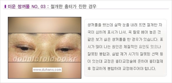 [두한성형외과 경쟁력 눈성형] - [나에게 맞는 맞춤 쌍꺼풀 찾기] 관련 이미지 3