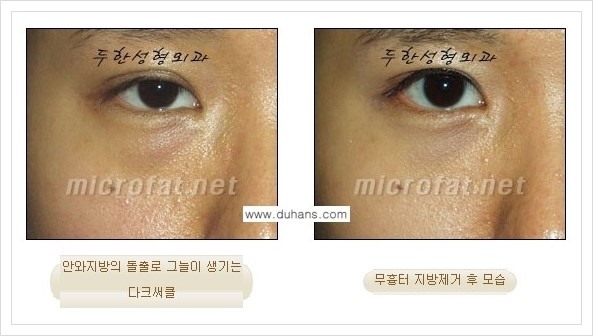 [두한성형외과 경쟁력 눈밑성형] - [눈밑지방제거, 눈위지방제거 안내 1.] 관련 이미지 22