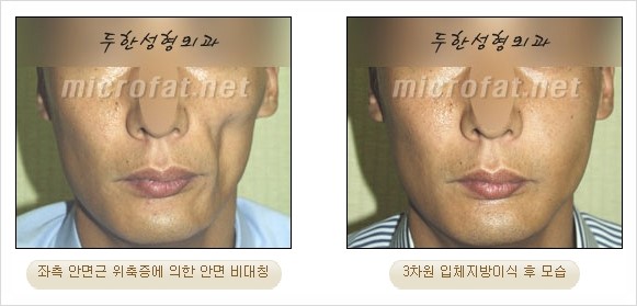 [두한성형외과 경쟁력 지방이식 리더] - [Col-fat(콜펫)지방이식, 3차원 입체지방이식, 2차원 평면지방이식] 관련 이미지 50