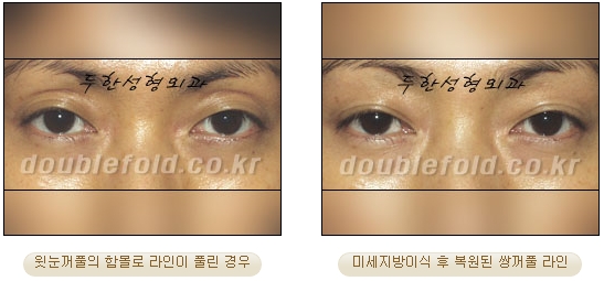 [Eye Reoperation Duhan Plastic Surgery] - [Guide to Double Eyelid Revision Surgery] image 63