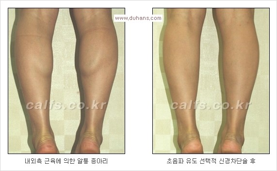 [두한성형외과 Dr. 컬럼] - [종아리 근육퇴축술로 가장 선호하는 비절개 초음파 유도 선택적 신경차단술] 관련 이미지 9