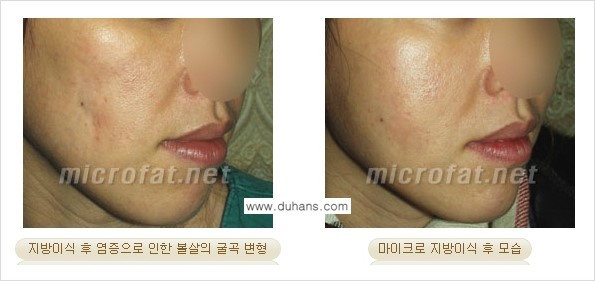 [두한성형외과 경쟁력 미세지방이식] - [지방이식 부작용 - 지방이식 후 발생한 굴곡현상에 대한 안내] 관련 이미지 6