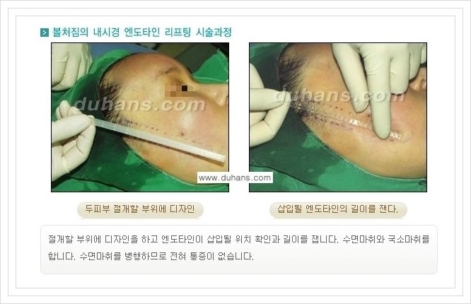 [두한성형외과 경쟁력 주름성형] - [회복과 일상으로의 복귀가 빠른 주름교정 엔도타인 리프팅] 관련 이미지 14