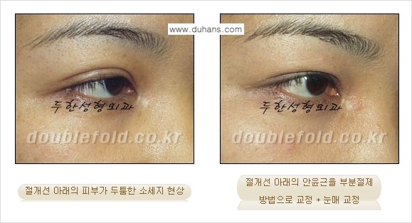 [두한성형외과 경쟁력 극한눈(쌍꺼풀)재수술] - [절개선 아래가 두툼한 소세지 쌍꺼풀 교정] 관련 이미지 4