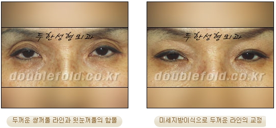[두한성형외과 쌍커풀수술] - [눈성형 방법에 대한 자주하는 질문과 답변] 관련 이미지 92