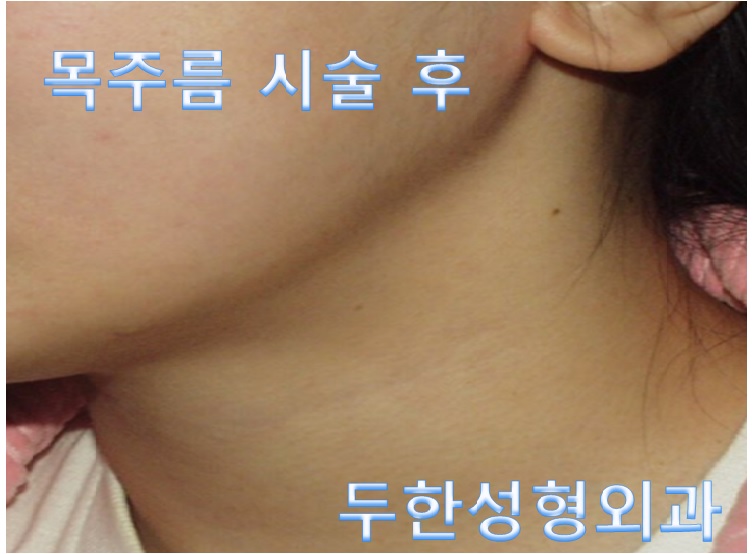 [두한성형외과 목주름]-[#목주름레이저 #목주름 #주름개선레이저 #주름교정] 관련 이미지 3