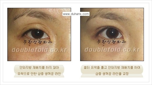 [두한성형외과 경쟁력 쌍꺼풀(눈) 재수술] - [쌍꺼풀(눈) 재수술, 극한 재수술 클리닉의 특성] 관련 이미지 6