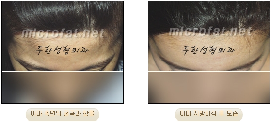 [두한성형외과 이마성형] - [엔도타인리프팅, 이마지방이식]​ 관련 이미지 33