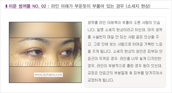 [두한성형외과 경쟁력 눈성형] - [나에게 맞는 맞춤 쌍꺼풀 찾기] 관련 이미지 2
