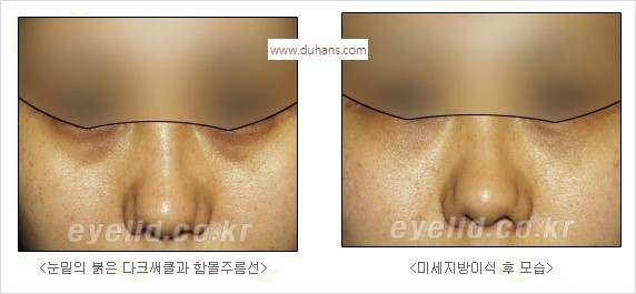 [두한성형외과 경쟁력 눈밑성형] - [눈밑 다크써클 수술 방법] 관련 이미지 17