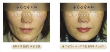 [두한성형외과 얼굴자가지방이식] - [지방이식 과정] 관련 이미지 38