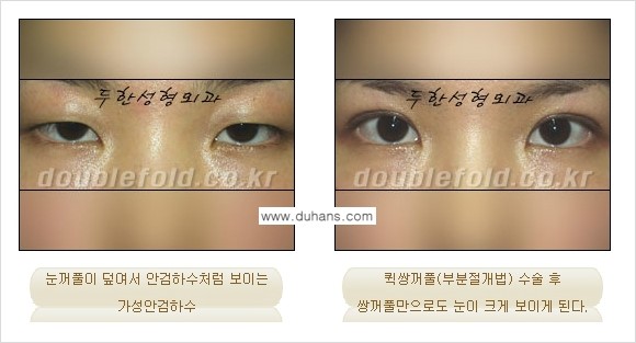 [두한성형외과 NO.1 "극한 눈(쌍꺼풀 재수술)"] - [안검하수(졸린눈매) 재수술 안내 3.] 관련 이미지 12