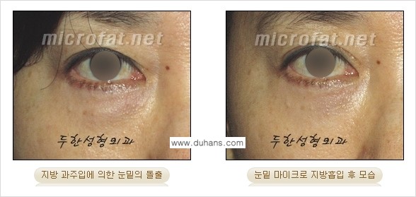 ​[두한성형외과 가을엔 지방흡입을] - [볼살, 눈밑, 턱선 초음파 미세지방흡입] 관련 이미지 13