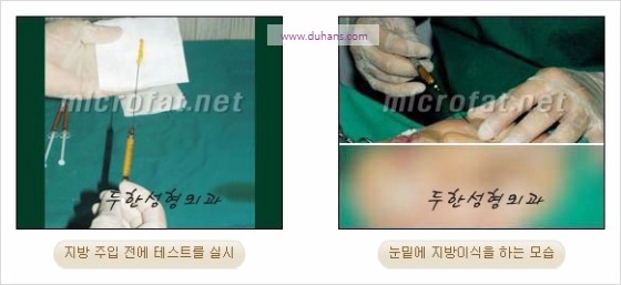 [두한성형외과 경쟁력 눈밑성형] - [눈밑애교살 필러 시술의 부작용 교정 방법] 관련 이미지 8