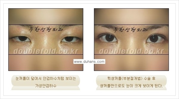 [두한성형외과 경쟁력 쌍꺼풀 재수술, 극한 눈 재수술] - [안검하수(졸리운 눈매) 재수술 안내] 관련 이미지 11