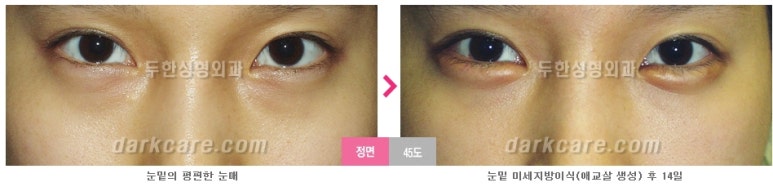 [두한성형외과 다크서클] - [다크서클 전후사진 검증] 관련 이미지 56