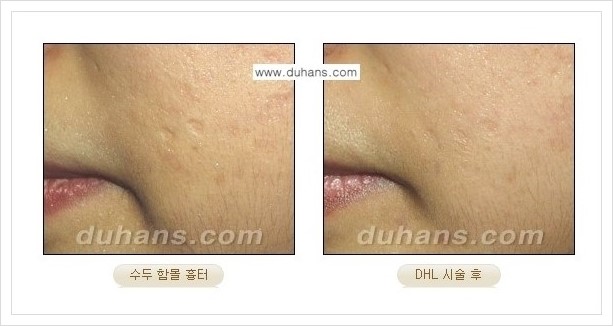 ​[두한성형외과 경쟁력 흉터성형] - [함몰흉터의 DHC 시술] 관련 이미지 3
