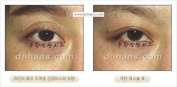 [두한성형외과 경쟁력 눈성형] - [Dr. 컬럼  "어떤 쌍꺼풀이 아름다운 쌍꺼풀인가?!] 관련 이미지 3
