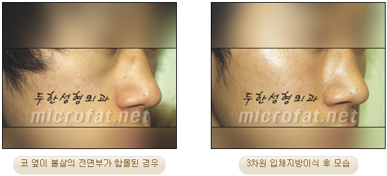 [Duhan Plastic Surgery Face Autologous Fat Grafting] - [Noble Surgery and Indian Band Fat Grafting] image 17