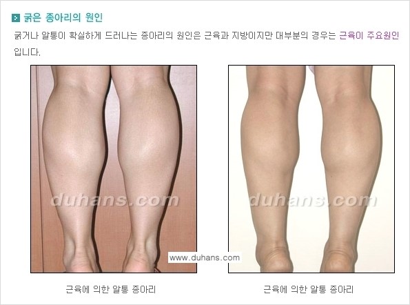 ​[두한성형외과 날씬한 종아리 만들기!] - [간편하고 안전한 종아리 축소방법 ①] 관련 이미지 5