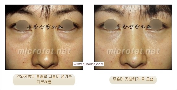 [두한성형외과 경쟁력 눈밑성형] - [과도한 눈밑지방제거의 부작용 후 눈밑지방재배치] 관련 이미지 8