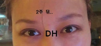 [Ptosis, Duhan Plastic Surgery] - [Sleepy-Looking Eyes, Ptosis Eye Correction] image 28