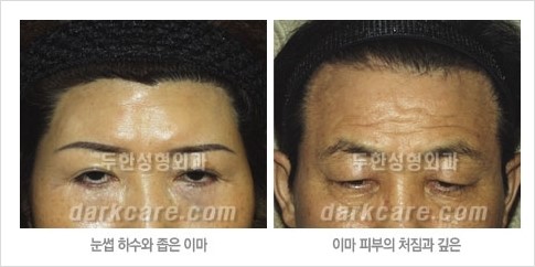 [두한성형외과 경쟁력 주름성형] - [주름제거를 위한 리프팅] 관련 이미지 13