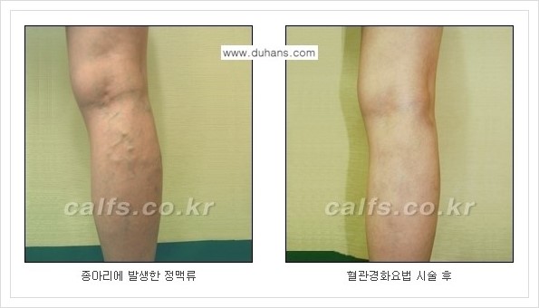 [두한성형외과 경쟁력 멀티종아리성형] - [나에게 맞는 종아리 시술 방법과 종류 안내 ③] 관련 이미지 14