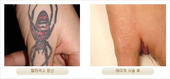 [두한성형외과 경쟁력 안전성형] - [최첨단 장비를 이용한 흉터, 점, 주근깨, 잡티, 문신제거 레이저 시술] 관련 이미지 34