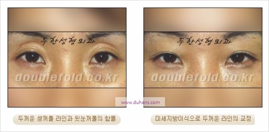 [두한성형외과 경쟁력 눈성형] - [쌍꺼풀 재수술에 대한 최선의 대안 제시] 관련 이미지 25