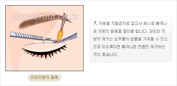 [두한성형외과 경쟁력 쌍꺼풀 재수술, 극한 재수술] - [쌍꺼풀 재수술의 과정 안내 2.] 관련 이미지 10