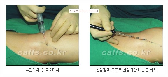 ⁠⁠[두한성형외과 경쟁력 종아리성형] - [굵은 다리의 모양과 원인에 따른 종아리성형 방법] 관련 이미지 5