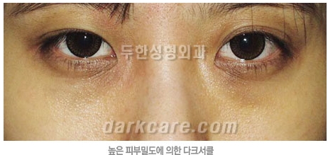Duhan Plastic Surgery Dark Circle Improvement - What Causes Dark Circles? What Types of Dark Circles Are There? image 16