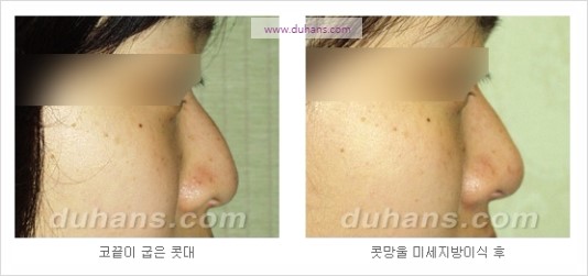 [두한성형외과 경쟁력 코성형] - [코를 높히는 지방이식] 관련 이미지 13
