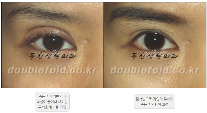 [Double Eyelid Surgery Duhan Plastic Surgery] - [Revision Methods] image 35
