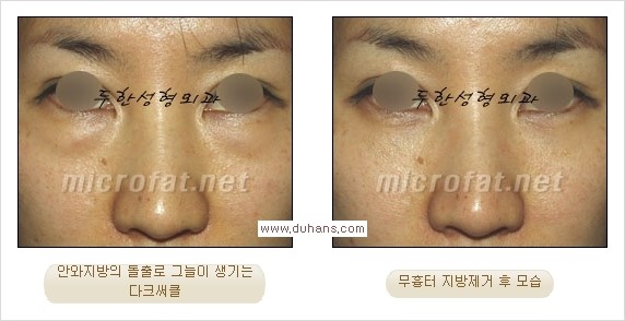 [두한성형외과 경쟁력 눈밑성형] - [과도한 눈밑지방제거의 부작용 후 눈밑지방재배치] 관련 이미지 11