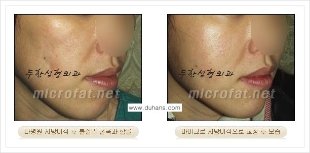 [두한성형외과 경쟁력 볼살지방이식] - [타병원 지방이식 후 - 굴곡이 발생한 경우, 과주입으로 인해 볼살이 불룩한 경우 안내] 관련 이미지 6