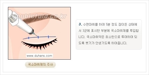[두한성형외과 경쟁력 쌍꺼풀 재수술, 극한 재수술] - [쌍꺼풀 재수술의 과정 안내 1.] 관련 이미지 13