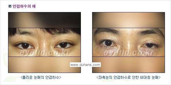 [두한성형외과 경쟁력 눈성형] - [안검하수와 몽고주름에 대한 자주하는 질문과 답변] 관련 이미지 1
