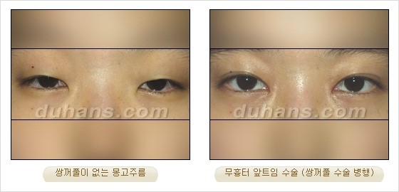 [DuHan Plastic Surgery Eye Surgery] - [Guide to Epicanthoplasty and Canthoplasty for Increasing the Horizontal Width of the Eyes] image 20