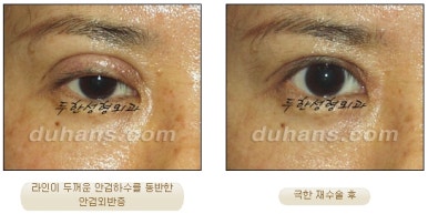 [Special Double Eyelid Revision Surgery at Duhan Plastic Surgery] - [Restorative Surgery for Damaged Double Eyelid Eye Shape] image 12