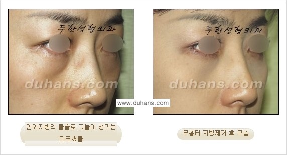 [두한성형외과 젊은 눈매 안검성형] - [눈밑 지방제거의 수술 전후 안내 ②] 관련 이미지 17