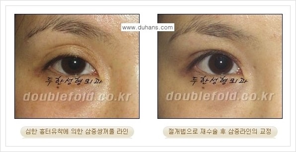 [두한성형외과 경쟁력 쌍꺼풀 재수술, 극한 재수술] - [삼중(세겹) 쌍꺼풀 라인의 교정 안내] 관련 이미지 3