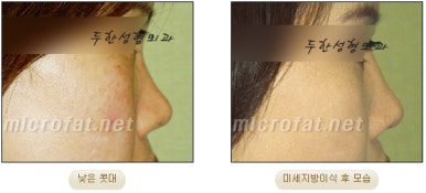 [Duhan Plastic Surgery Facial Fat Grafting] - [Fat Grafting Rhinoplasty] image 14