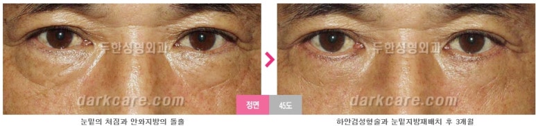 [두한성형외과 눈밑수술] - [눈밑지방재배치의 적응증] 관련 이미지 5