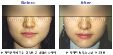 [Duhan Plastic Surgery Clinic Aesthetic Procedures] - [Square Jaw Botox] image 23