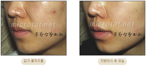 Wrinkle Improvement, Duhan Plastic Surgery - Mouth Lines, Nasolabial Folds image 9