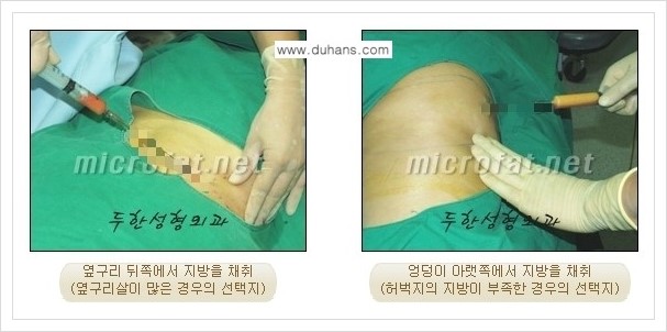[두한성형외과 경쟁력 미세지방이식] - [두한 미세지방이식 클리닉의 특징 안내] 관련 이미지 6